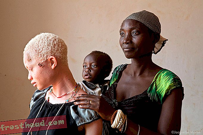 articles, arts et culture - Où Albinisme signifie être ciblé pour meurtre ou mutilation