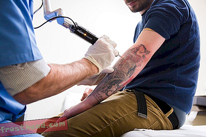 Z lasersko tehnologijo je lažje odstranjevanje tetovaže kot kdajkoli prej