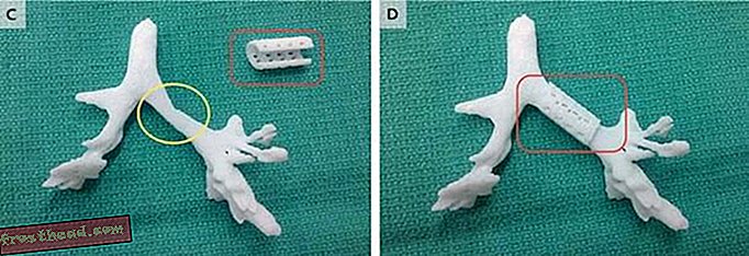 La distribution imprimée en 3D de la trachée et des bronches de Giondriddo, que l’attelle a implantée dans l’image de droite.