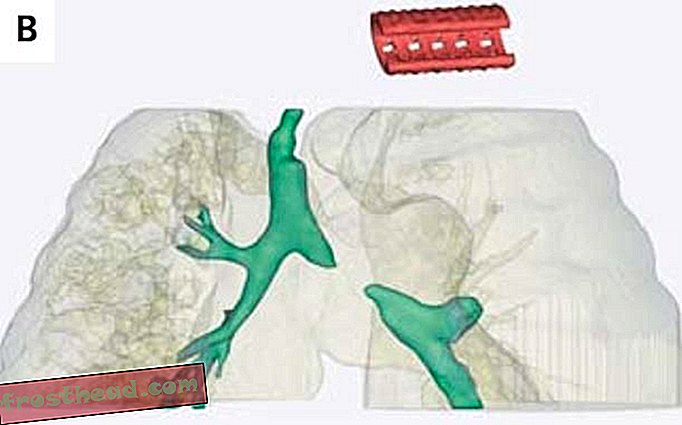 Лекарите използват разтварящ се 3D-отпечатан Tracheal Splint, за да запишете a