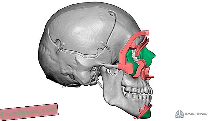 Obrázek vytvořený 3D modelováním dárce transplantace obličeje. Kontrastní barvy poskytují řezné vodítko pro chirurgické plánování podle pacienta.