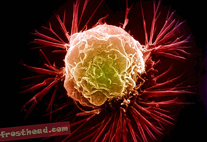 artikler, innovation, sundhed og medicin, videnskab, sind og krop - Brug af zink til at opdage brystkræft tidligt