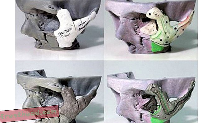 Os modelos e implantes produzidos usando impressão 3D.