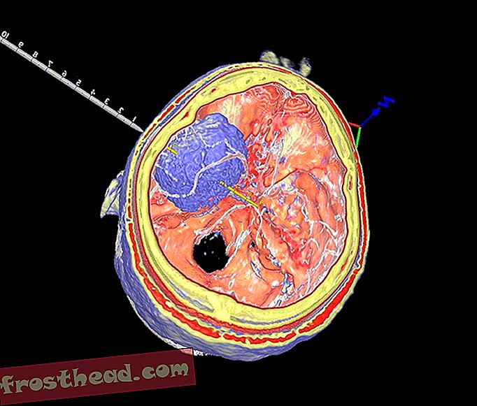 फ्यूजन के- ट्यूमर-सीटी और MRI.jpg