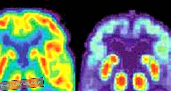 Kako laseri mogu biti odgovor na Alzheimerovu bolest