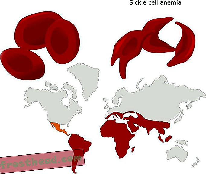 La anemia falciforme y la malaria
