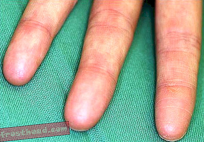 Adermatoglyfie: Genetická porucha lidí narozených bez otisků prstů