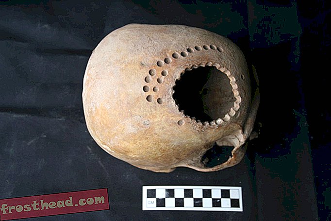 Prije tisuću godina, pacijenti su preživjeli moždani zahvat, ali morali su živjeti s ogromnim rupama u glavi