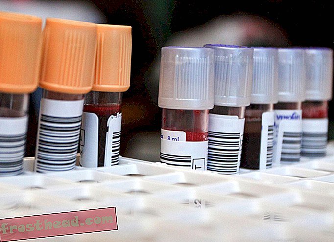 La FDA approuve un test sanguin pouvant détecter les commotions cérébrales