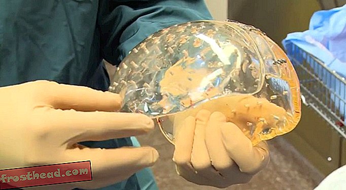 smarte nyheder, smarte nyhedsvidenskab - Du kan se den første operation nogensinde for at transplantere en 3D-trykt kranium i en persons hoved