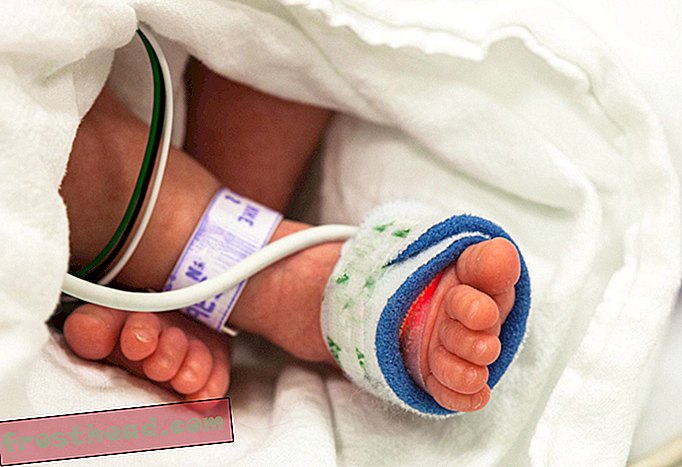 Una niña en Colombia nació con su gemela dentro de su abdomen
