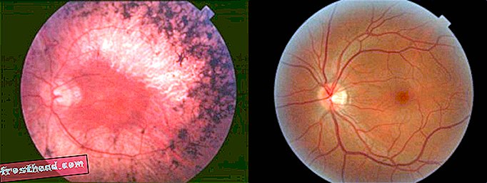 Новоодобрените ретинални импланти могат да помогнат на слепите хора да видят