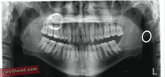 Forhistoriske mennesker havde bedre tænder end vi gør